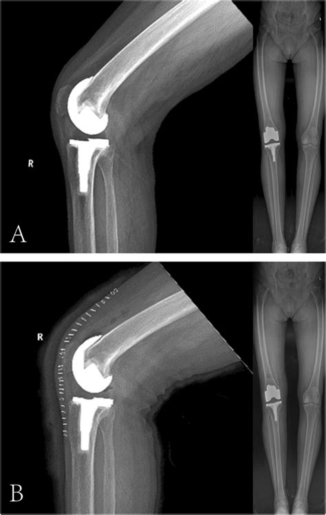 A Pre Revision Standing Anterior Lateral Radiograph Of The Right Knee