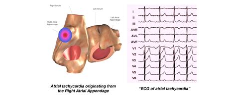 SVT EP Study & Ablation - One Heart Cardiology