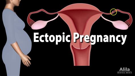 Ectopic Pregnancy Animation Youtube