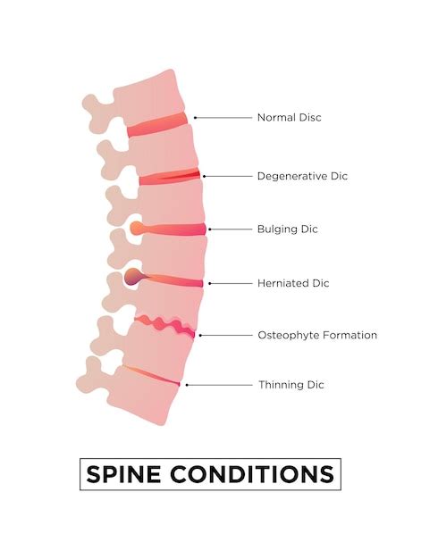 Premium Vector | Stages of spinal osteochondrosis