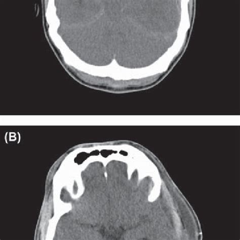 Pre Operative A And Post Operative B Ct Scans Note The Lack Of Download Scientific Diagram