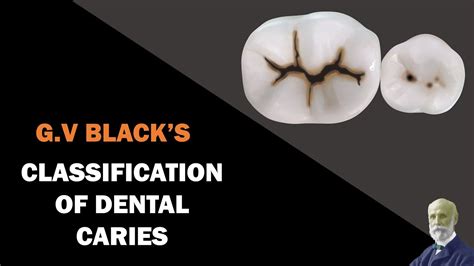 Classification Of Dental Caries Gv Blacks Classification Youtube