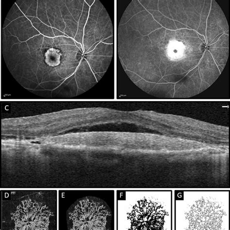 Multimodal imaging of a patient with neovascular age-related macular... | Download Scientific ...