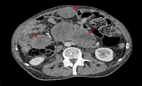 Ct Scan Of The Abdomen Showing The Secondary Peritoneal Masses Download Scientific Diagram