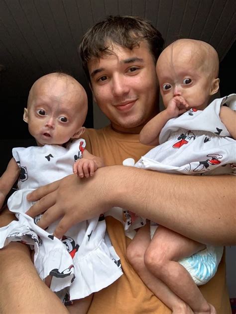 Rare Meet The Brazilian Twins With Benjamin Button Syndrome Archyde