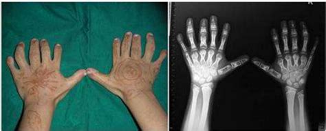 Clinical And Radiographic Appearance Of Hands Showing Polydactyly And Spoon