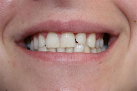 Casos Cl Nicos Cl Nica Dental Almu Car Dentalmu Car Tu Dentista