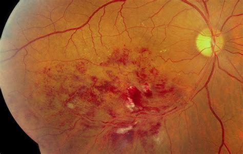 Retinal Vein Occlusions - Retina Specialists of Michigan