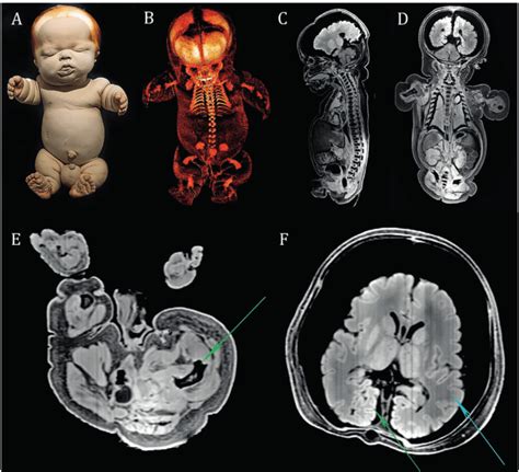 A Photograph Of The Full Term Fetus Of Case 1 B 3D Reconstructed