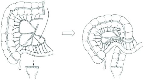 Retro Ileal Anastomosis Through An Ileal Mesenteric Defect For