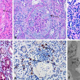 Pathological findings of the renal biopsy. The major finding of the ...