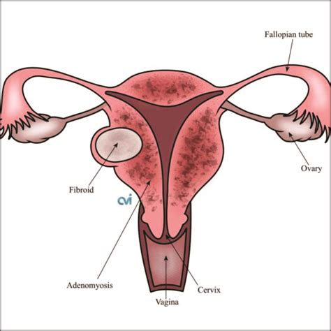 Adenomyosis Women S Clinic BTM Dr Brunda Channappa And Dr Kavita P M