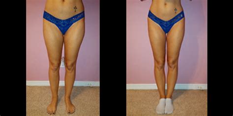 Before And After Cellulite Reduction By Dr Nwizu