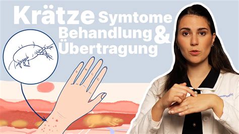 Krätze erkennen behandeln Was hilft bei infizierten Möbeln Dr med