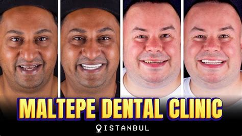 Maltepe Dental Clinic Istanbul 🦷🇹🇷 Before And After From Myself