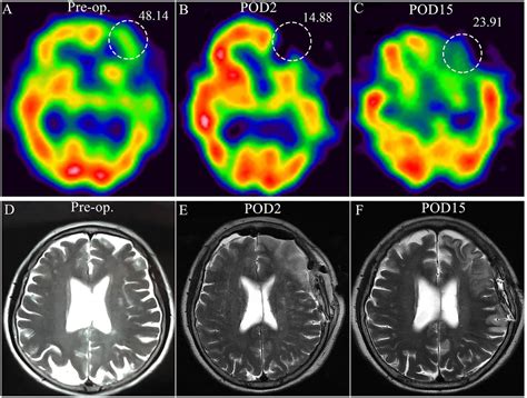 Paradoxical Association Of Symptomatic Cerebral Edema With Local