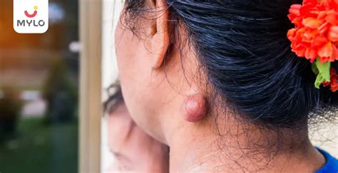 Sebaceous Cyst : Causes, Symptoms & Treatment