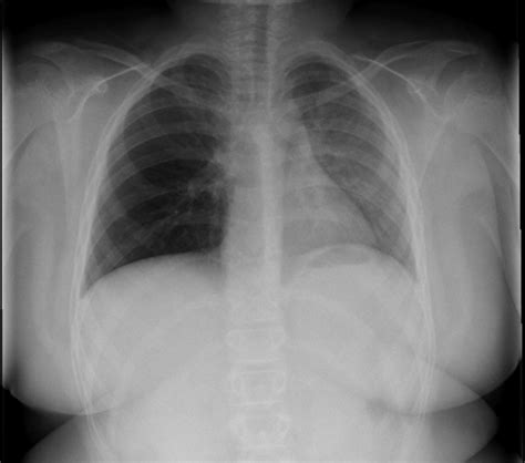 Foreign Body Ingestion/Aspiration – Undergraduate Diagnostic Imaging ...