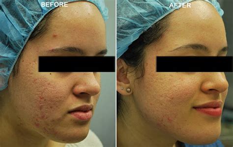 Large Pores Treatment | Hellman Dermatology