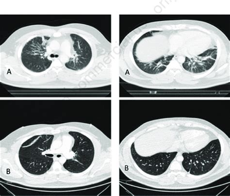 Findings Of The Chest X Ray Inflation Of The Right Hilum And Linear