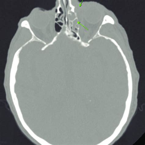 ct  orbits  contrast showing opacification  left frontal sinus