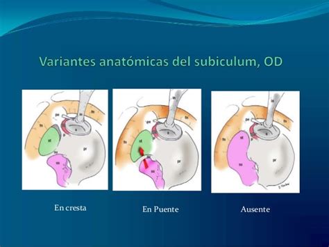 Timpanoplastia Endoscopica