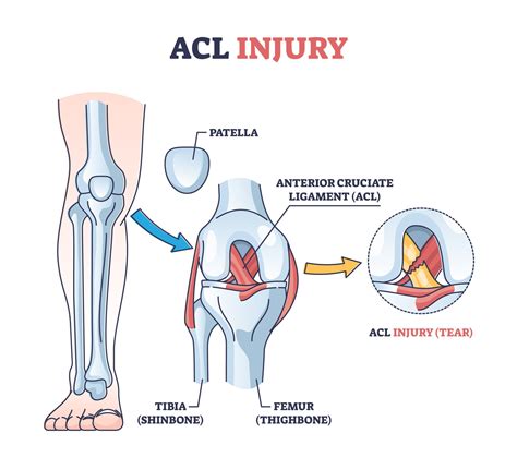 Common Knee Injuries