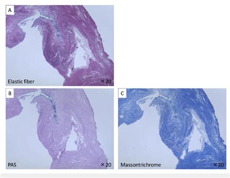 Histological Analysis Of The Soft Tissue Filling The Fossa Navicularis Download Scientific