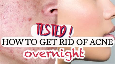 How To Get Rid Of Acne Overnight Guaranteed Less Acne TESTED