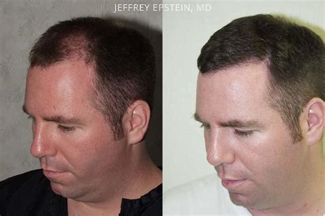 Hair Transplants For Men Photos Miami Fl Patient