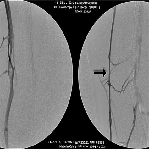 Preoperative Venogram Of Right Lower Extremity RLE Great Saphenous