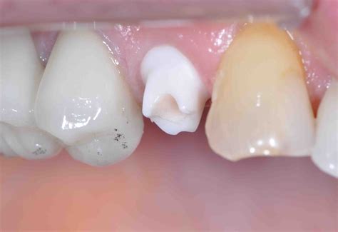 Screw Retained Versus Cement Retained Implant Crowns - Lee Ann Brady DMD