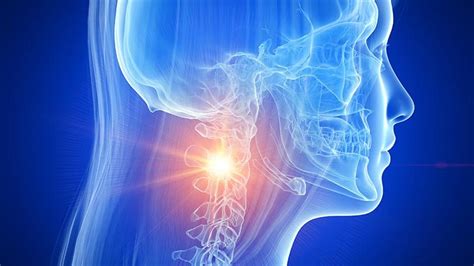 Síntomas causas y cómo tratar la artrosis cervical