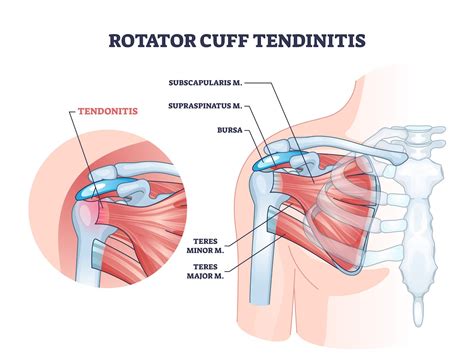 8 Exercises For Shoulder Tendonitis Alexander Orthopaedics