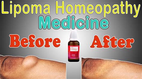 Lipoma Homeopathic Medicine For Lipoma Part