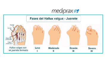 Qué es el Juanete o Hallux Valgus Higea Fisioterapia