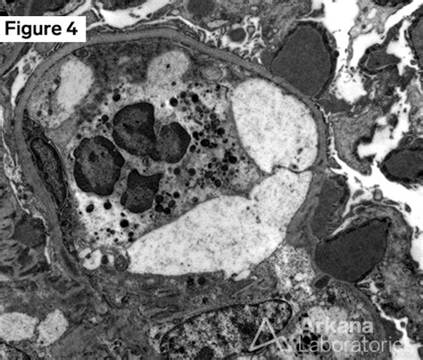 Psagn Post Streptococcal Acute Glomerulonephritis Case