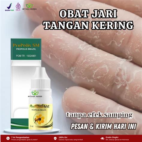 Jual Obat Jari Tangan Kering Dan Pecah Obat Telapak Tangan Mengelupas