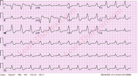 Accelerated Idioventricular Rhythm (AIVR) or slow VT ECG Example 3 ...