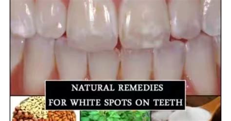 Health Do You Have White Spots On Your Teeth These Natural Remedies Help Get Rid Of It