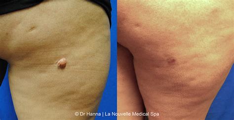 Mole Removal Before And After Photos By Dr Hanna Ventura