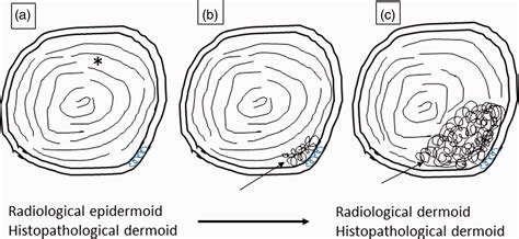 Epidermoid Cyst Diagram