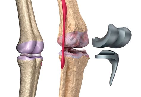 Protesis De Rodilla Archivos Dr Omar Perales