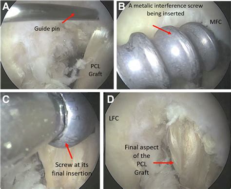 Figure 1 From Onlay Technique For Posterior Cruciate Ligament