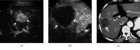 Figure 1 From Percutaneous Ultrasound Guided Thermal Ablation For