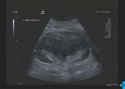 Renal Hematoma Ultrasound