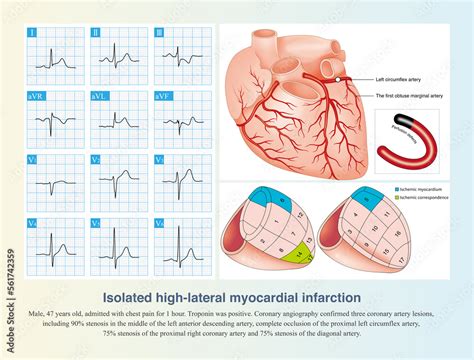 Isolated Occlusion Of Left Circumflex Artery Can Lead To Isolated High