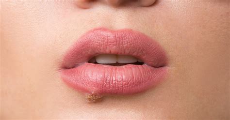 Cold Sore Vs Canker Sore On Lip