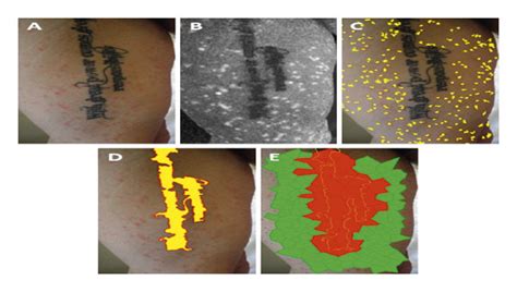 Psoriasis And Tattoo 1 A Clinical Picture B Retained A∗ Color