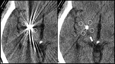 Metal Artifact Reduction In Head Ct Performed For Patients With Deep